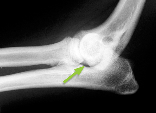 X-rays of a Cocker Spaniel with a painful elbow due to the two bones in the forearm, the radius and ulna, growing at different rates. The joint is deformed with a gap visible (small arrow). The ulna bone has been cut and lengthened so that the gap in the joint is no longer visible (large arrow). The bone has been stabilised with a metal pin. It healed within four months.