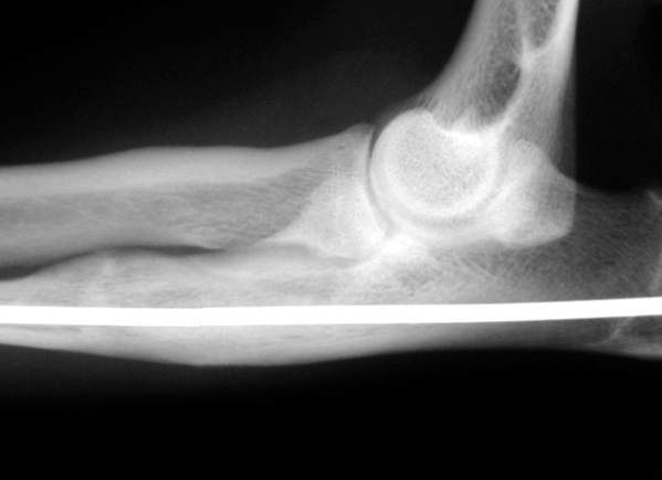 X-rays of a Cocker Spaniel with a painful elbow due to the two bones in the forearm, the radius and ulna, growing at different rates. The joint is deformed with a gap visible (small arrow). The ulna bone has been cut and lengthened so that the gap in the joint is no longer visible (large arrow). The bone has been stabilised with a metal pin. It healed within four months.