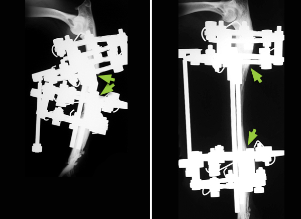 The second operation the ulnar bone was lengthened (compare the distance between the arrows in the two X-rays) using pins, rings and threaded connecting bars.
