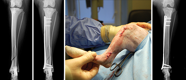 Repair of a tibial fracture by a minimally invasive technique using a plate and screws that were inserted through two small incisions in the skin. The X-ray on the right shows the same bone several weeks later when it has healed, giving an excellent outcome.