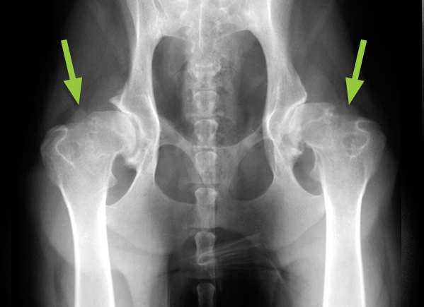 Radiograph showing hips with osteoarthritis (arrows)