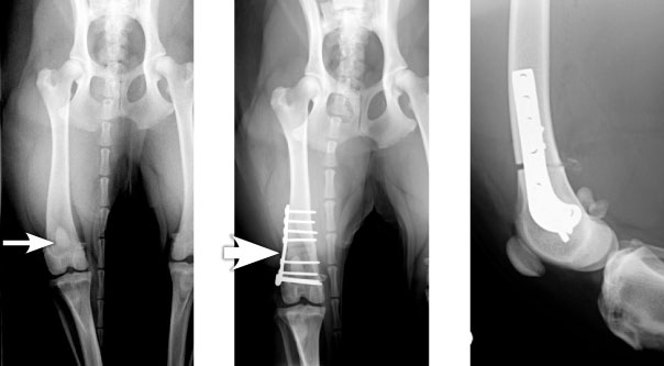 X-rays showing a femoral osteotomy to realign the quadriceps mechanism