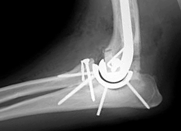 Post-operative radiograph (looking from the side) of a SIRIUS elbow replacement that uses a combination of cemented and cementless prostheses (implants)