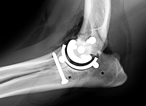 Post-operative radiograph (looking from the side) of a TATE elbow replacement that uses cementless prostheses (implants)