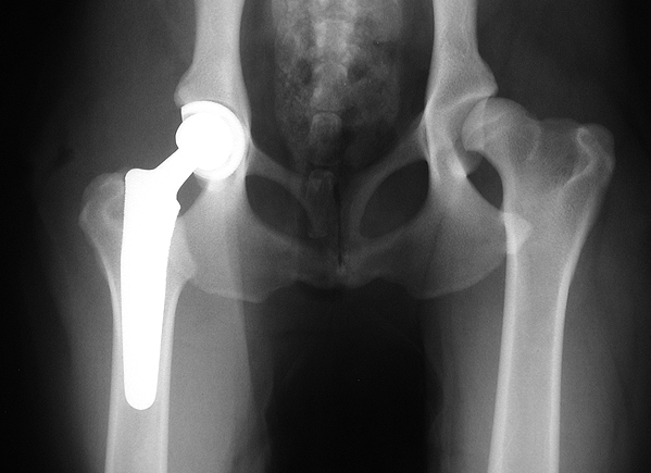 A cemented total hip replacement A cementless total hip replacement