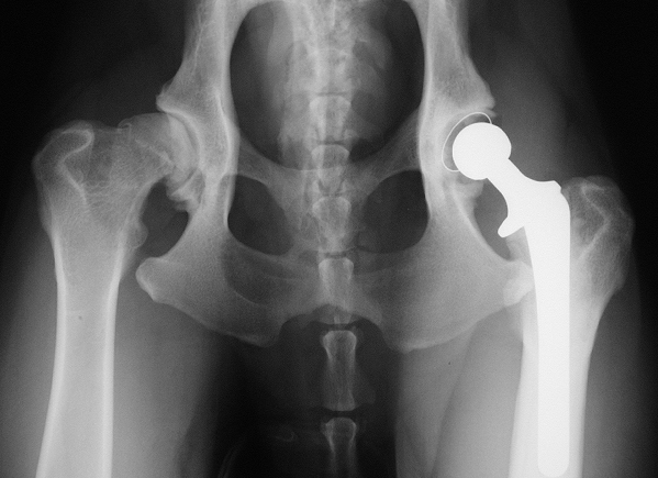 A cementless total
hip replacement