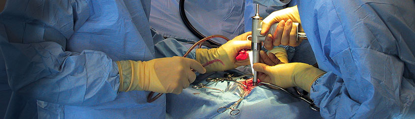 Total Hip Replacement Surgery (THR)