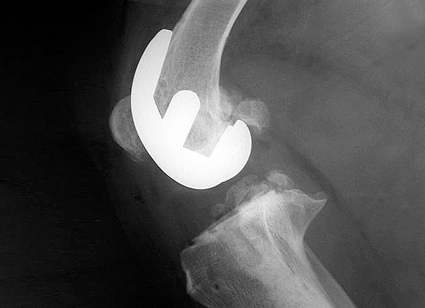 X-ray showing a total knee replacement