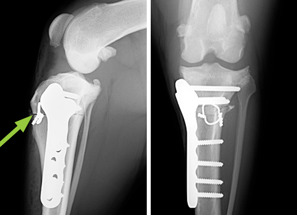 X-rays showing plate and screws following tibial wedge osteotomy (TWO) surgery to level the tibial plateau. A wedge of bone has been removed and the gap at the front of the bone closed with the aid of a loop of wire (arrow)