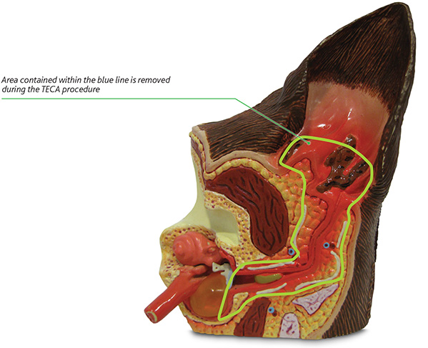 Figure 3 - shows a model of diseased ear and indicates the structures that are removed during TECA surgery