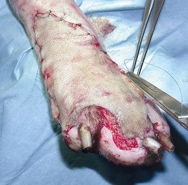 This intra-operative photograph shows the free skin graft being sutured in position. The potential success or failure of this procedure was dependent not only upon the quality of the surgical procedure, but also in large part upon the patient’s post-operative management, including the dressings which were applied following the operation