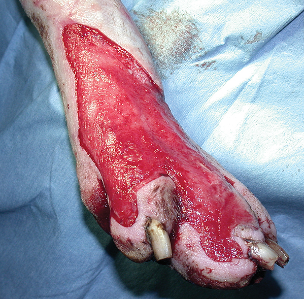 A skin defect following a road traffic accident that was treated by application of a free skin graft (see below). Before the skin graft procedure was performed, the wound was carefully managed using different dressing techniques to ensure the tissue was suitable to receive the graft