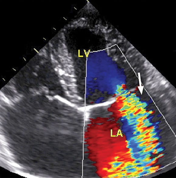 Heart murmur coloured diagram over scan
