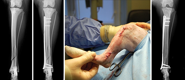 repair-of-a-tibial--fracture-by-a-minimally-invasive-technique