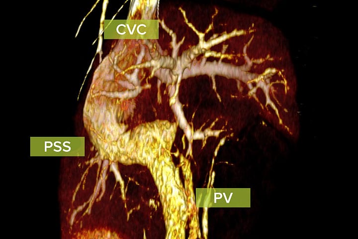 Computed Tomography Angiography 3D visualisation of the portal and systemic vasculature identifying the shunting vessel