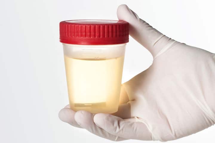 urine-testing-for-bladder-cancer-1