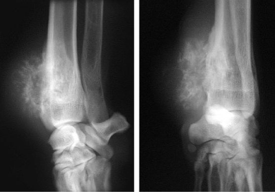 X-rays showing both destruction of bone and irregular new bone formation in a Great Dane with an osteosarcoma affecting the end of the radius (bone in the forearm)